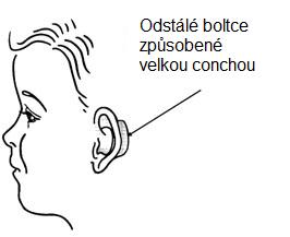 otoplastika2