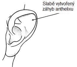 otoplastika3
