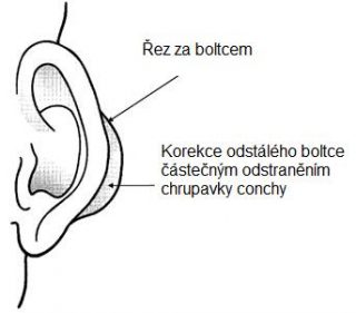 otoplastika4