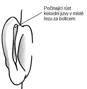 otoplastika6