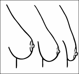 augmentace4