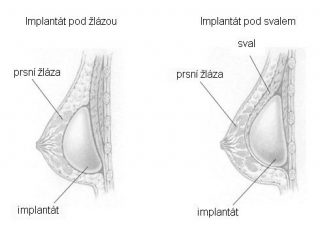 augmentace5