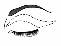 blefaroplastika2