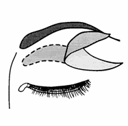 blefaroplastika3