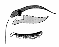 blefaroplastika4
