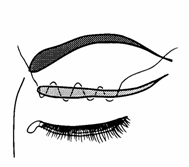 blefaroplastika5