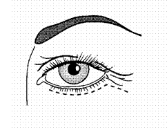 blefaroplastika6