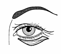 blefaroplastika7