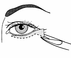 blefaroplastika8