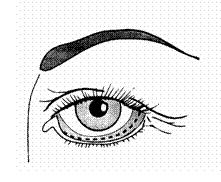 blefaroplastika9