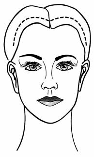 browlift5