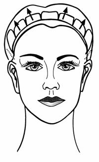 browlift6