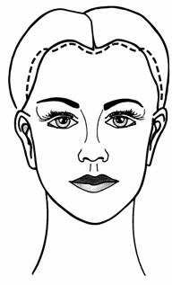 browlift7