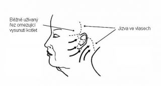 facelift4