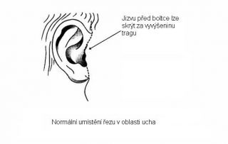 facelift5