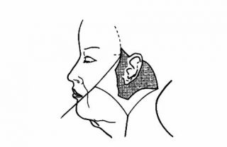 facelift6