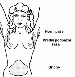 liposukce1