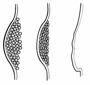 liposukce10