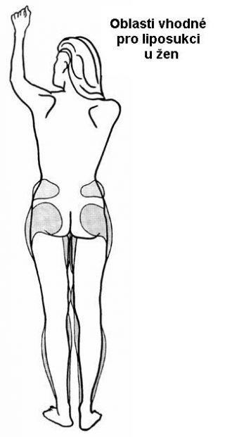 liposukce3