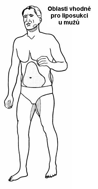 liposukce4