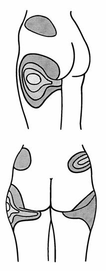 liposukce8