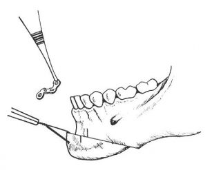 profiloplastika2