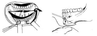 profiloplastika3