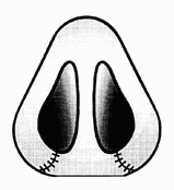 rhinoplastika12