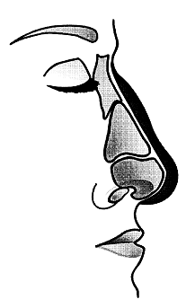 rhinoplastika3
