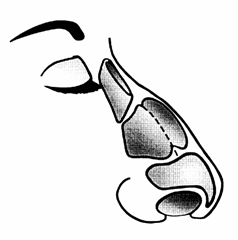 rhinoplastika8